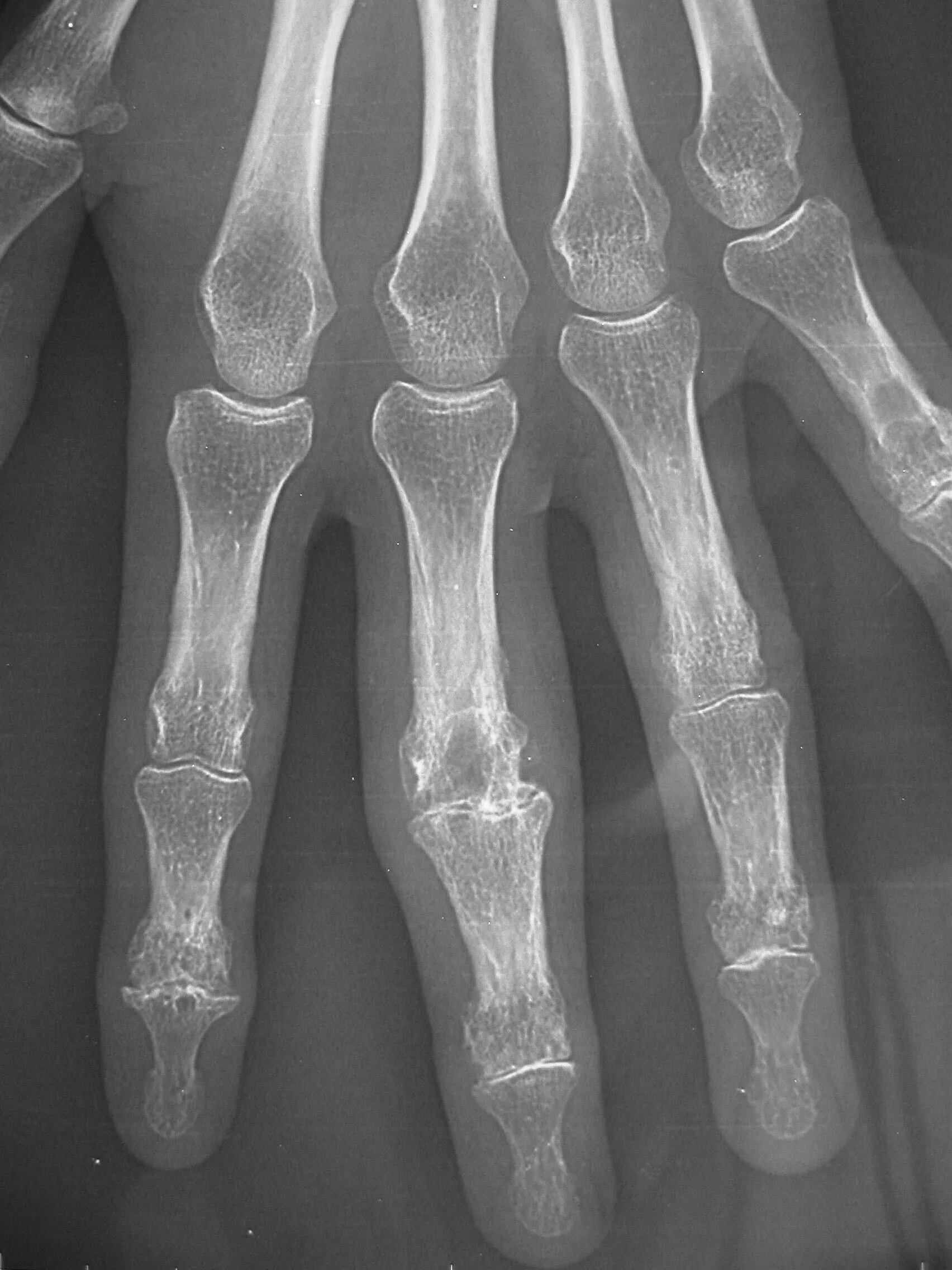 Reduced bone density